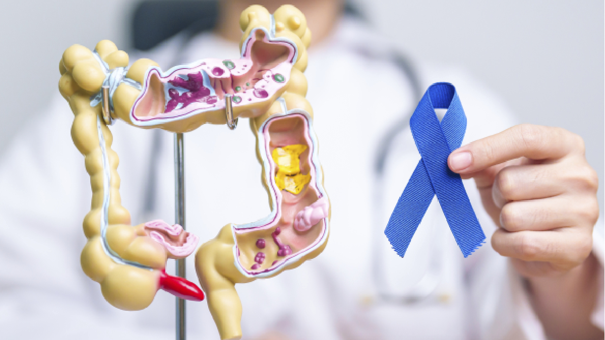 Hasta el 90% del cáncer colorrectal puede curarse con detección temprana