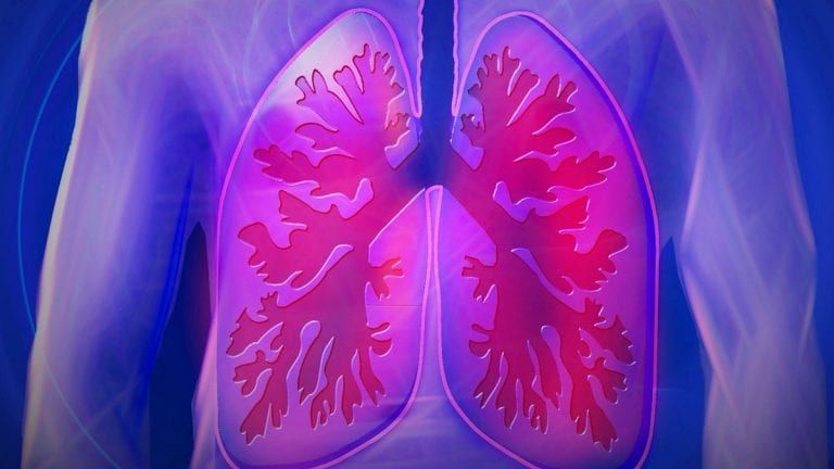 Neumonía por Covid-19 puede dejar importantes secuelas respiratorias en pacientes con Fibrosis pulmonar idiopática
